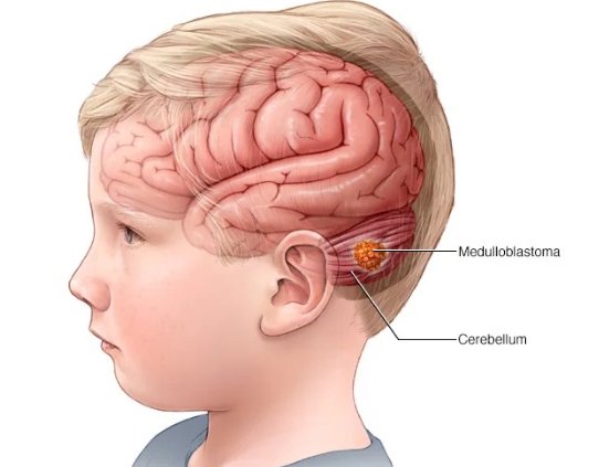 Understanding Brain Tumors: Early Detection Saves Lives