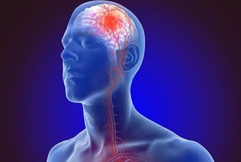 Recognizing a Stroke: Every Second Counts